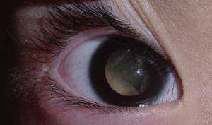 Đồng tử trắng - retinoblastoma