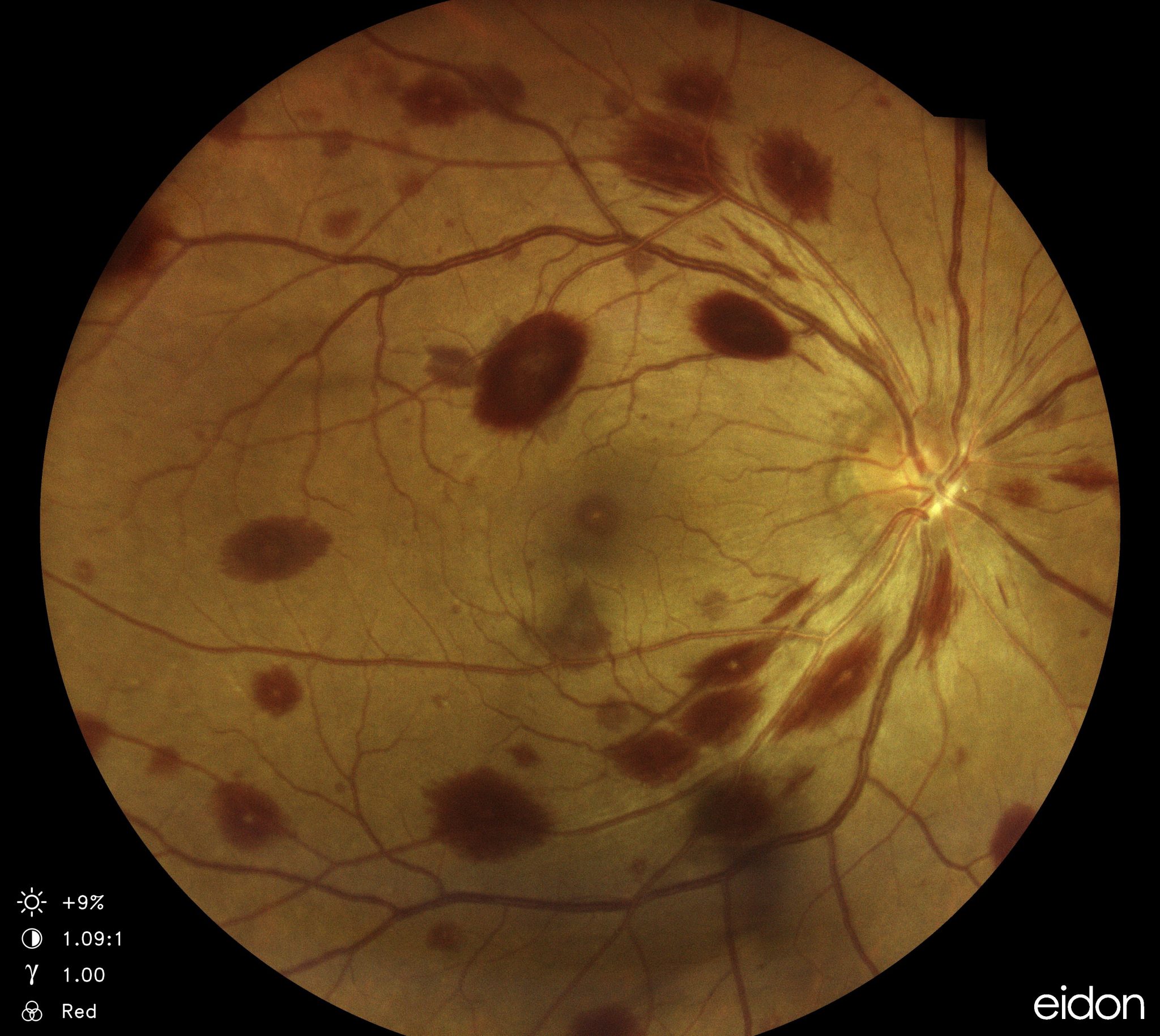 Red Spot Roth Spot Xuất huyết võng mạc chấm trắng (Roth’s spots) sau mổ cắt bè củng mạc ...