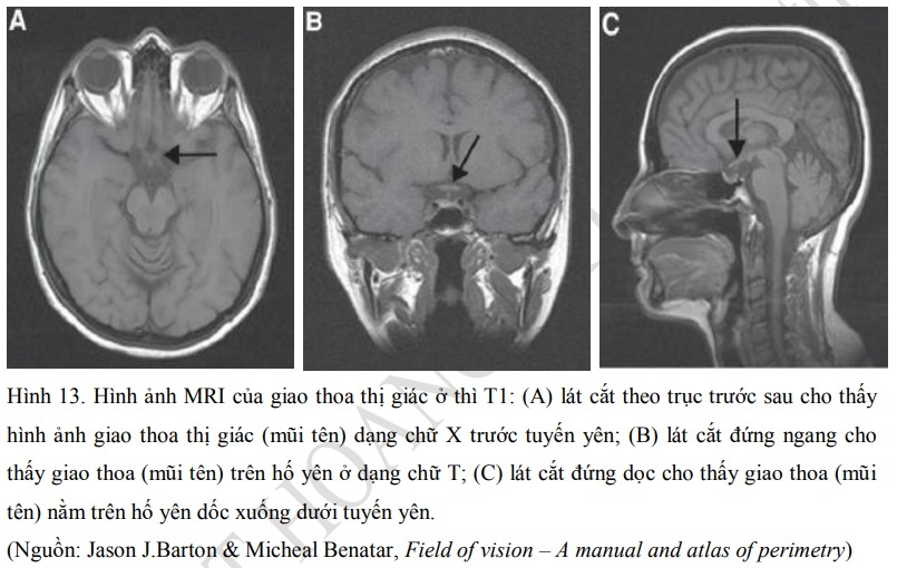 Hình ảnh giao thoa thị giác trên MRI