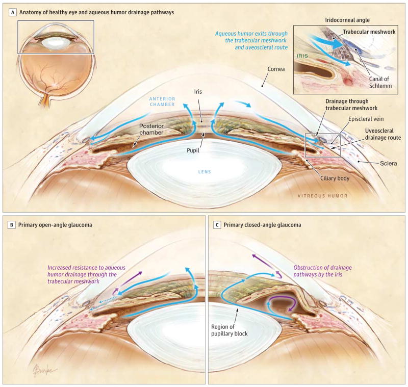 Con đường lưu thông thủy dịch ở mắt bình thường (A),glôcôm góc mở nguyên phát (B), glôcôm góc đóng nguyên phát (C).