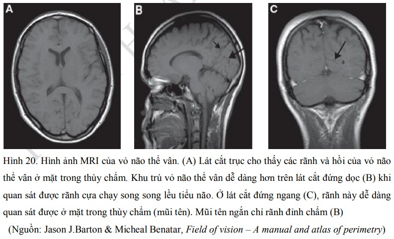 Hình ảnh MRI của vỏ não thể vân