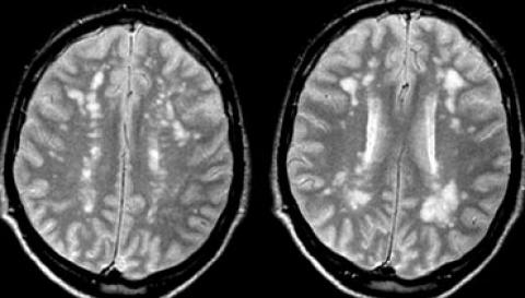 Tổn thương chất trắng bệnh xơ cứng rải rác trên MRI