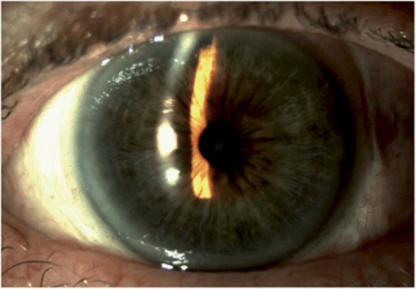 Lỗ cắt mống mắt chu biên bằng laser vị trí 12h
